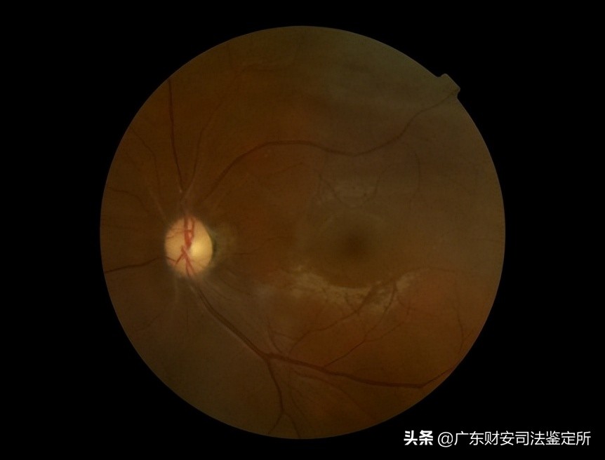 司法鉴定所对高坠伤致头面部损伤的法医临床鉴定