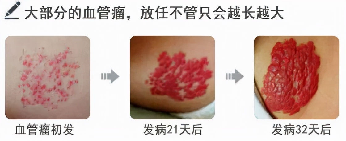 三,血管瘤的形成过程及症状表现,要认清!