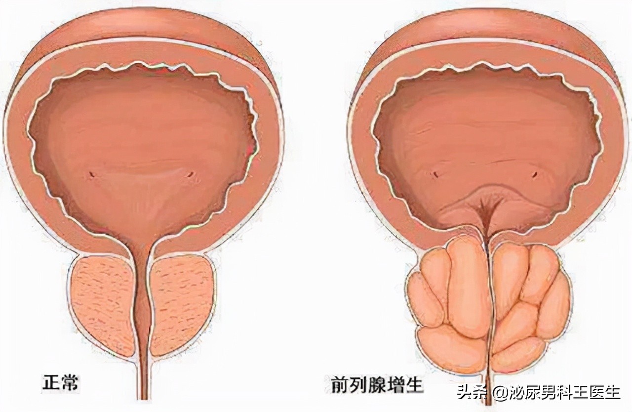 前列腺鈣化詳解,鈣化是怎麼引發的?有什麼表現?怎麼治療?