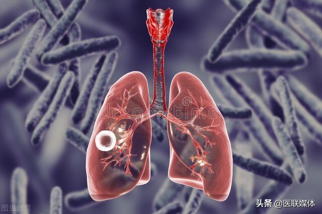 肺部结节是怎么形成的（明明自己不抽烟）