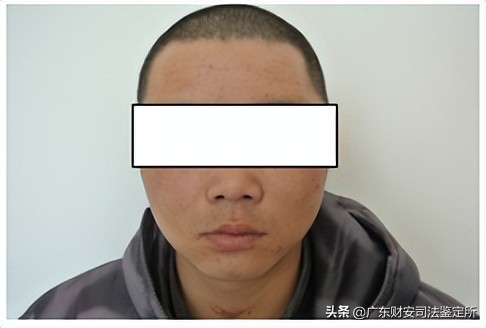 司法鉴定所对高坠伤致头面部损伤的法医临床鉴定