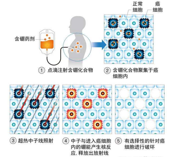 10万元，30分钟就能清除癌细胞？国产抗癌“硼药”，明年或将上市