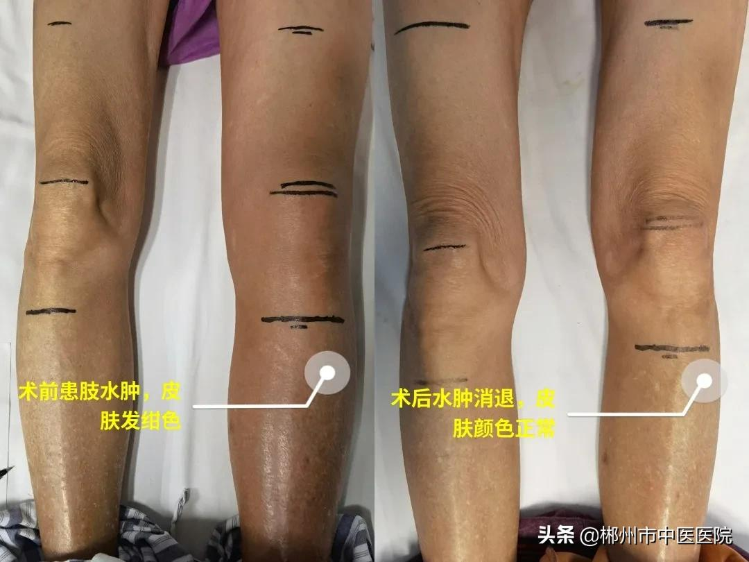 面对血栓!我们该怎么办?