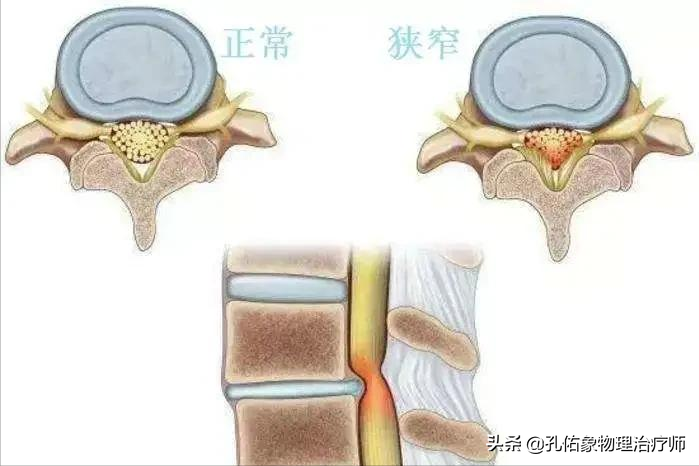 腰椎管狹窄引發的腰腿痛,行走費力,怎麼辦?5種方法詳盡告知