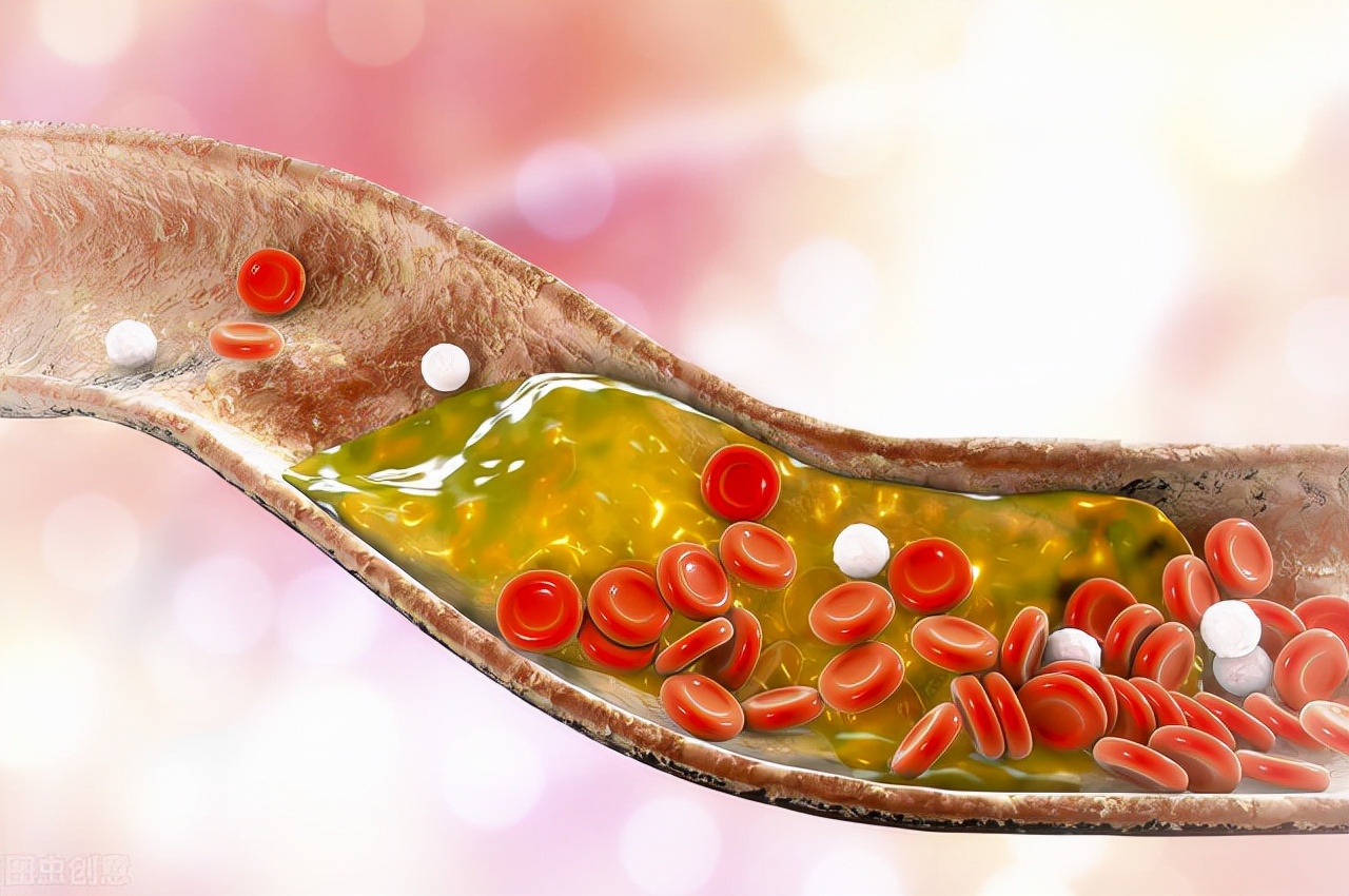 软化血管的4大误区您知道几个？医生提醒：延缓血管硬化需注意4点