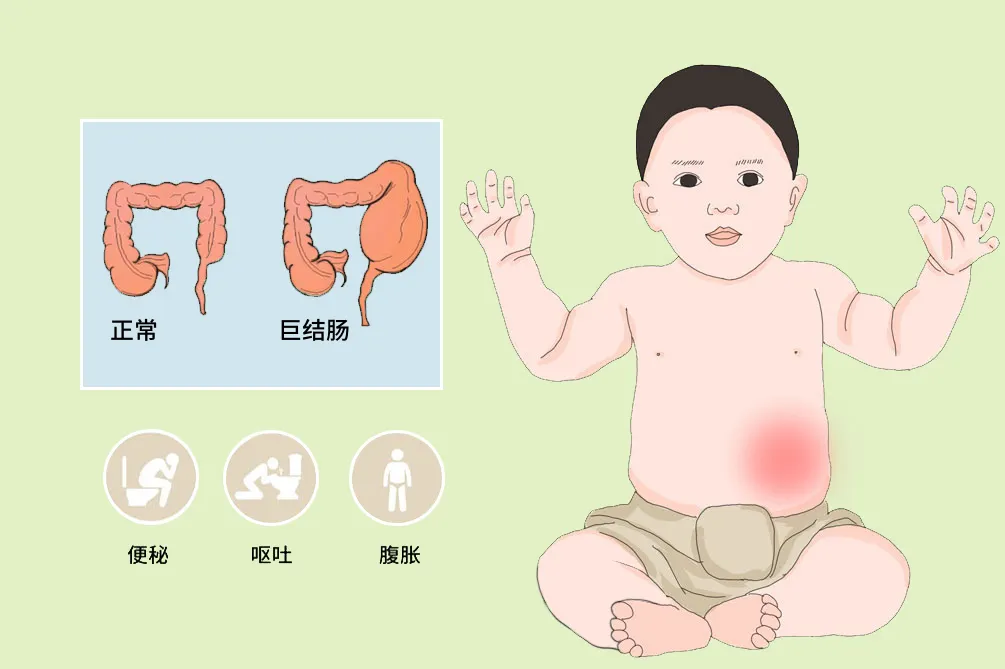 少女腹痛疑似肠梗阻,灌肠后解出8斤大便,医生:是先天性巨结肠