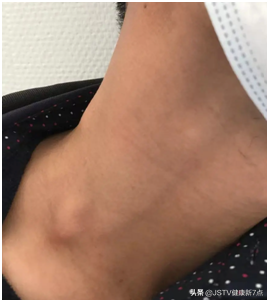 发现颈部肿块要当心