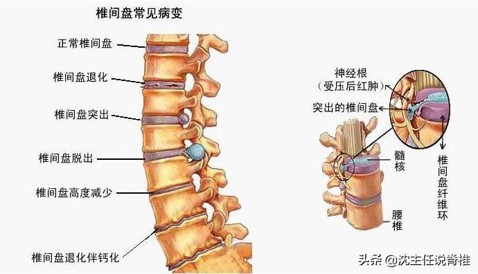 燕子飞动作图（腰椎间盘突出练习小燕飞的作用）