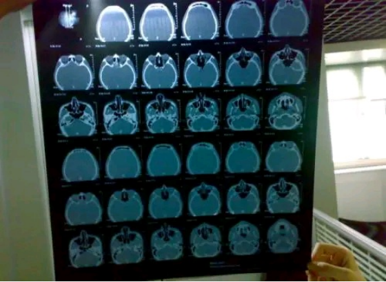 CT做多了会致癌？做一次CT，对人体的伤害有多大？你知道真相吗？