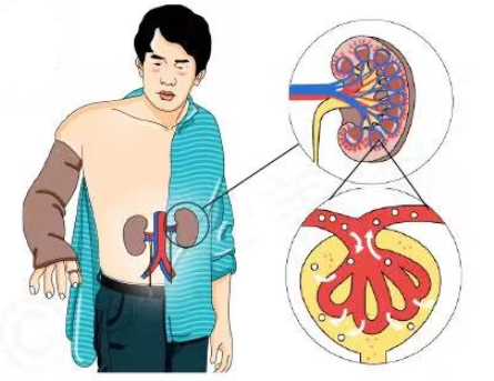 远离糖尿病肾病，从您点开这篇文章开始