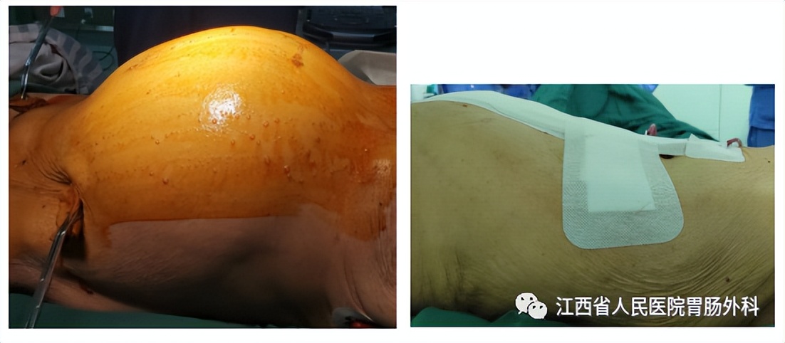 仁医医术| 鲐背老人“拆弹记”