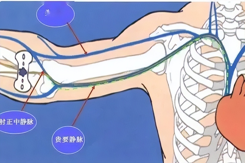 血管条件不好 抗肿瘤患者输液通路该怎么选择？