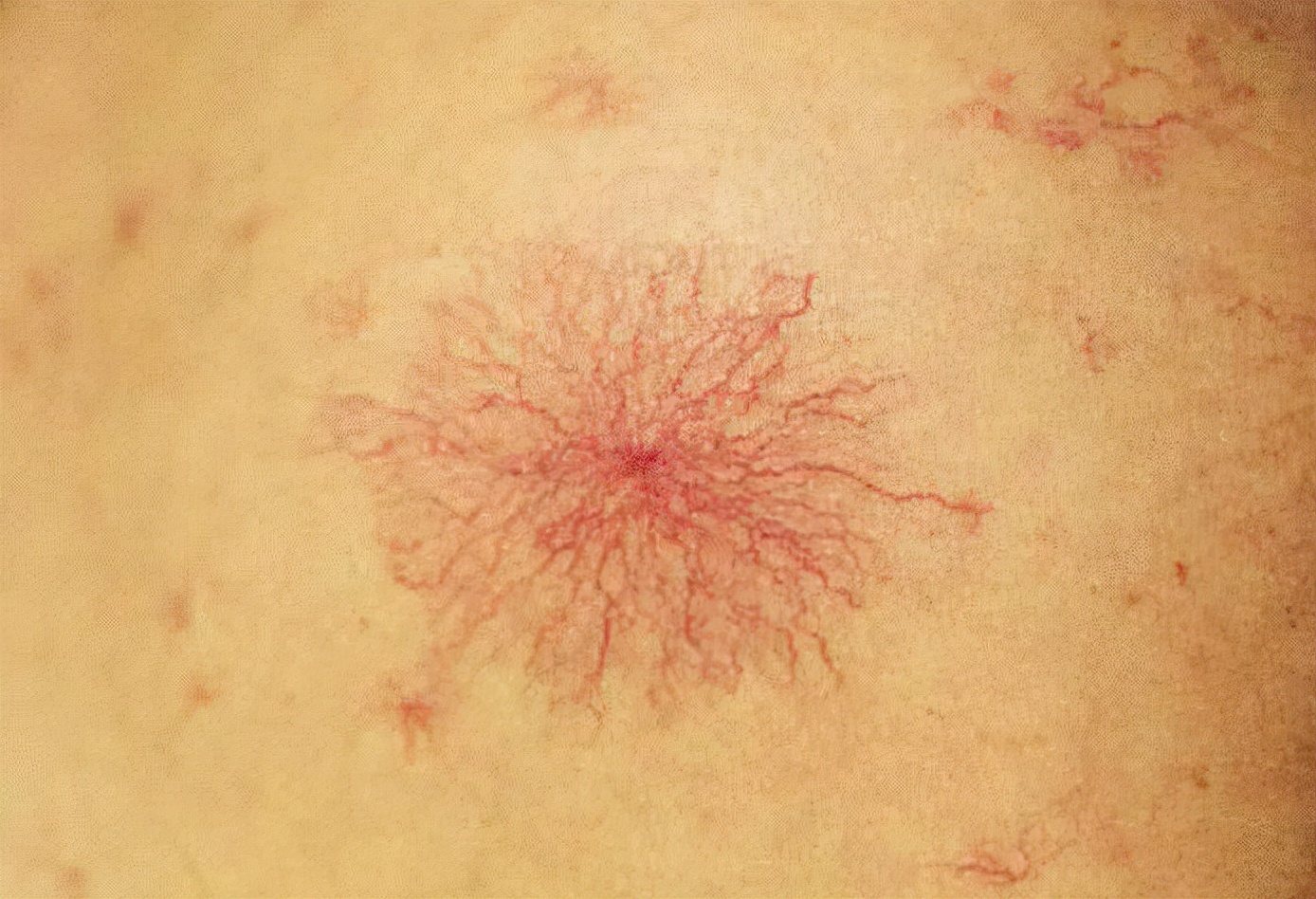 转氨酶升高代表什么？如何才能降低转氨酶？医生说出了答案