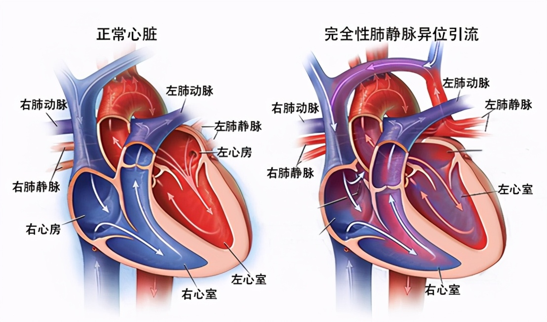 家长留心！新生儿口唇发紫、呼吸道感染，可能是这种心脏病引起的