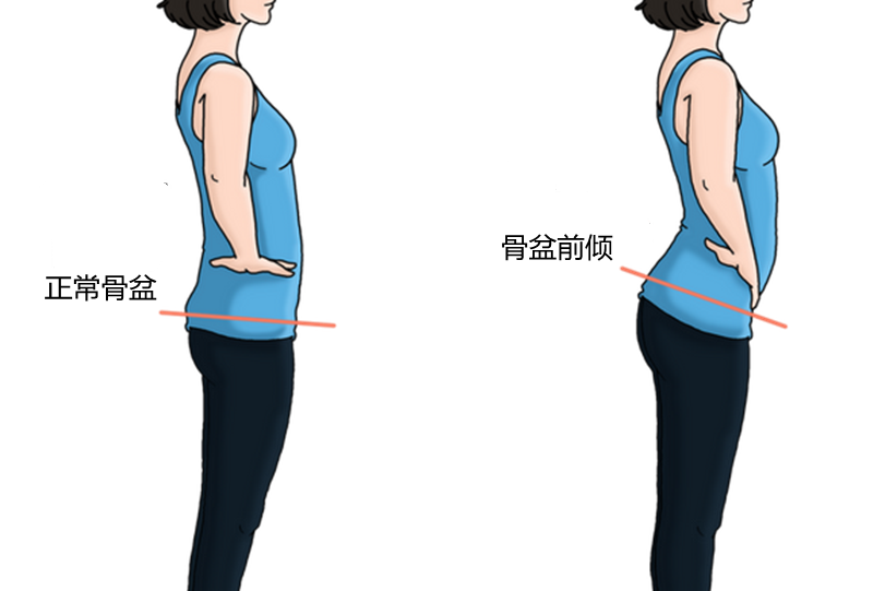 骨盆前倾开始没有症状,患者渐渐地感觉腰不舒服,影响体型和外观,尤其
