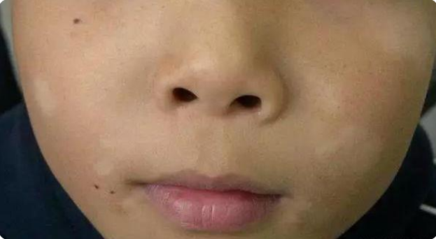 01,孩子脸上长白斑,警惕"蛔虫白斑"