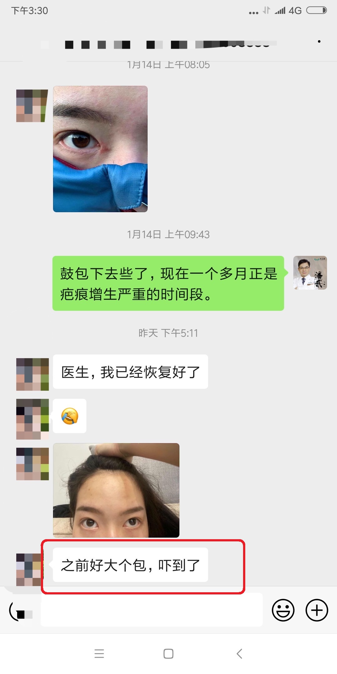 四川女子整容失败：我当初就不应该去开内外眼角，做多了只会变丑