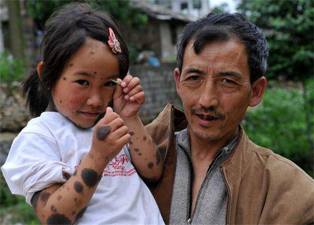 女孩60%皮肤布满黑毛,2岁遭父母抛弃,被同龄人取"小猴子"外号