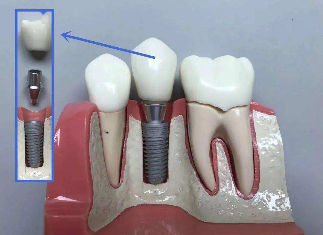 镶牙哪价格低掉牙后