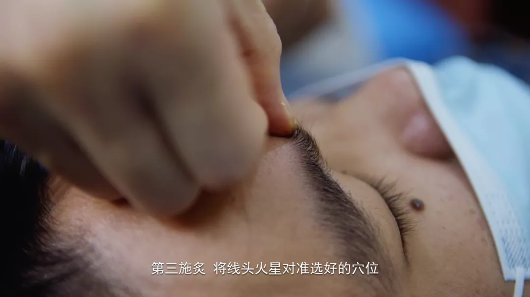 科普｜八桂中医大讲堂（22）：壮医药线点灸巧治红眼病
