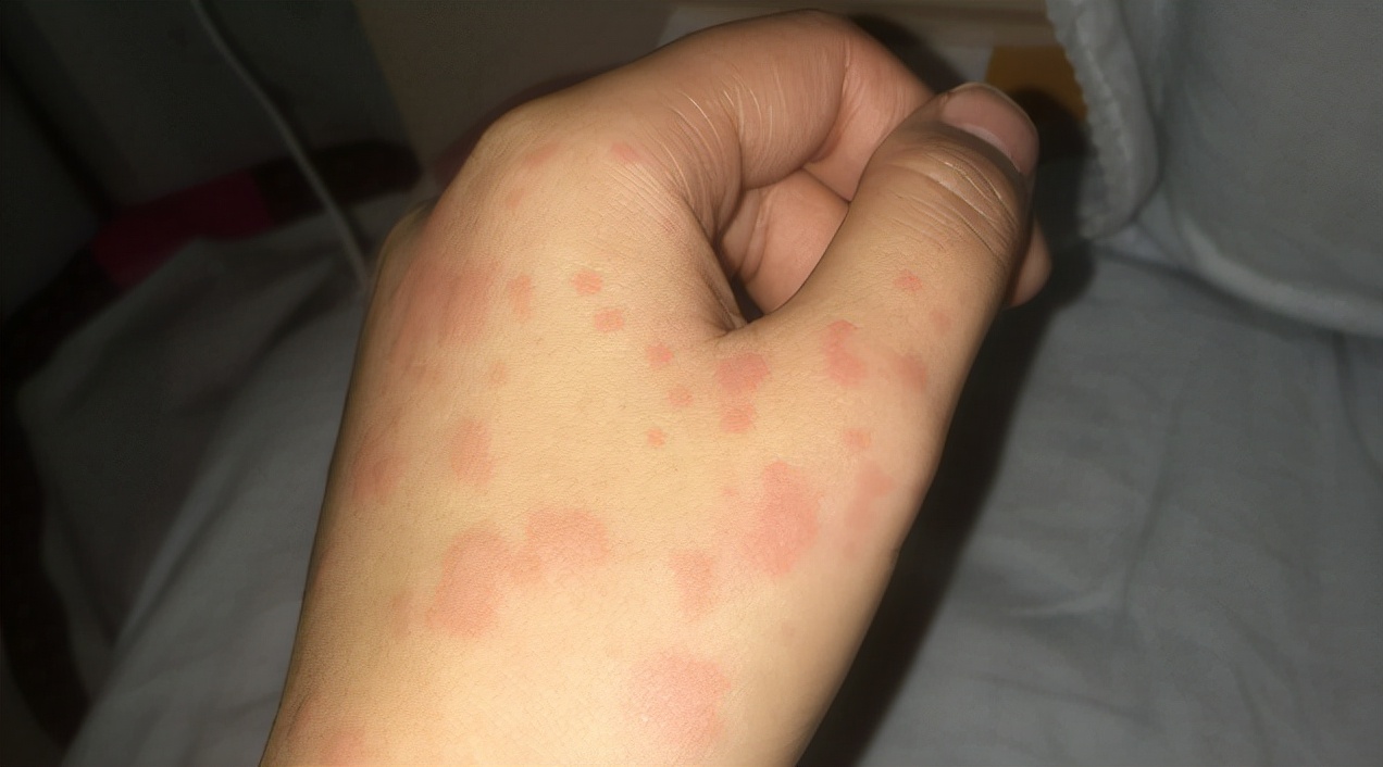 荨麻疹是由什么引起的?这5个"祸首",哪个都别小看