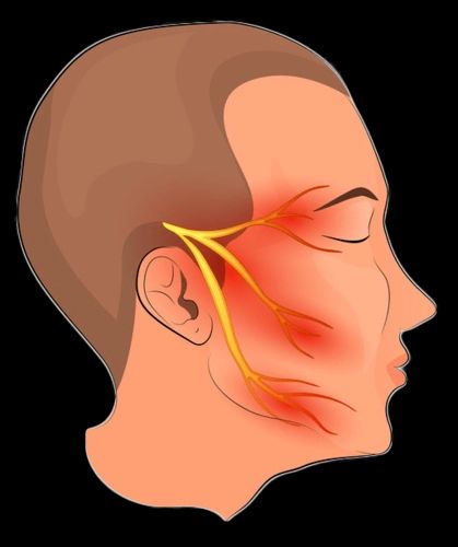 面部神经痛用什么药最好