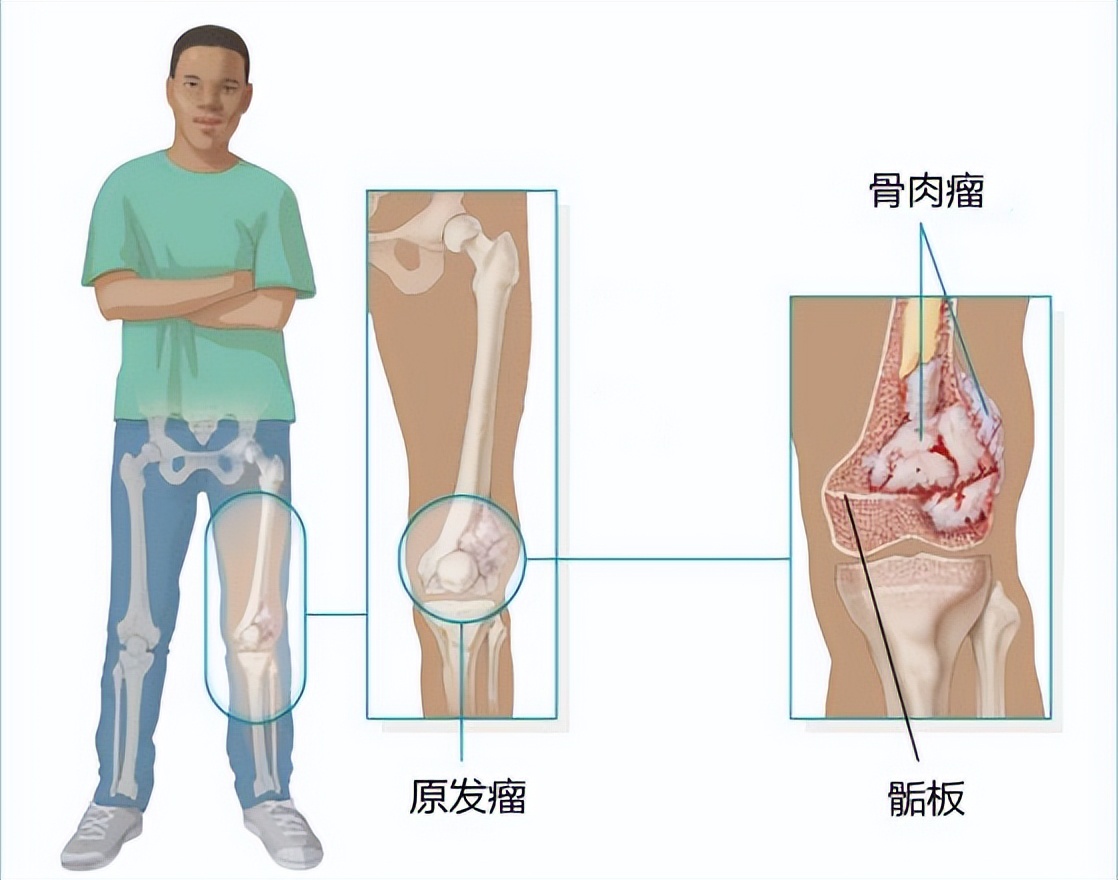 一文讀懂骨癌,早期有這4點徵兆