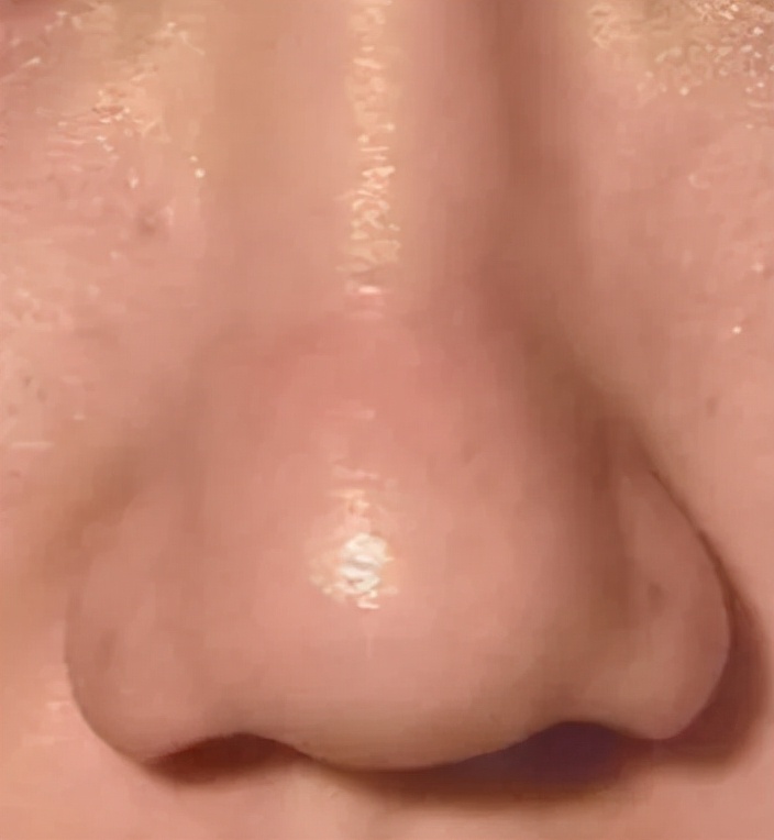 鼻头形态受到哪些因素影响