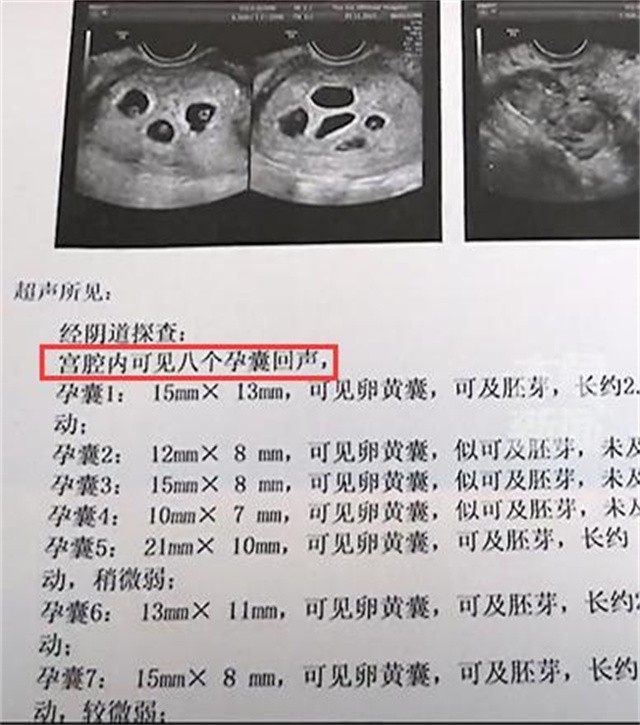 18岁准妈妈首次怀孕，检查后发现是8胞胎：想靠减胎术保留四五个