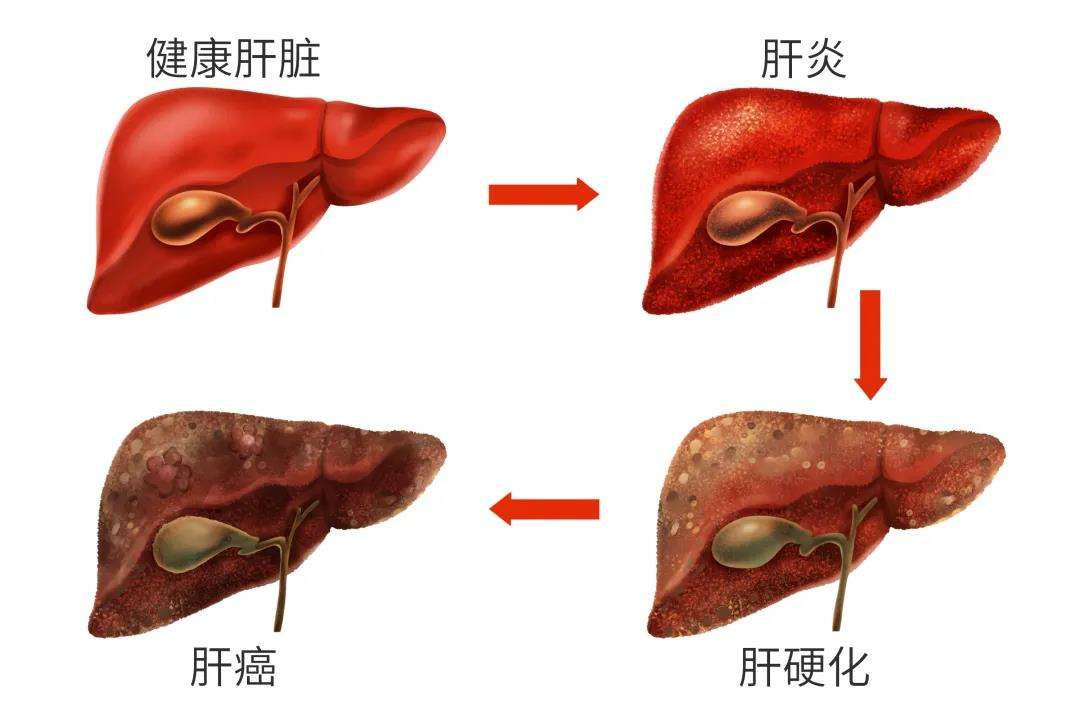 乙肝患者除了不能喝酒，這4種食物也要少碰，早知道早受益