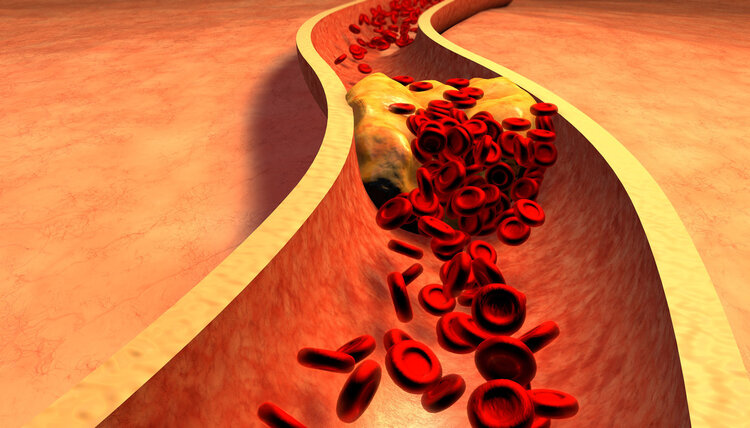 上海交大研究：胆固醇越低，癌症风险就越高？3种方法稳控血脂