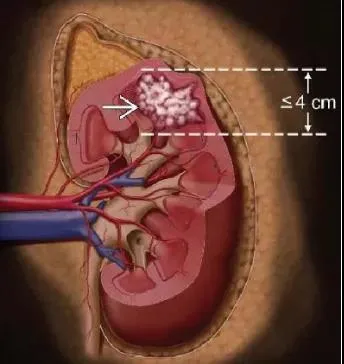 保肾 vs 肾全切，得了肾癌该如何选择？