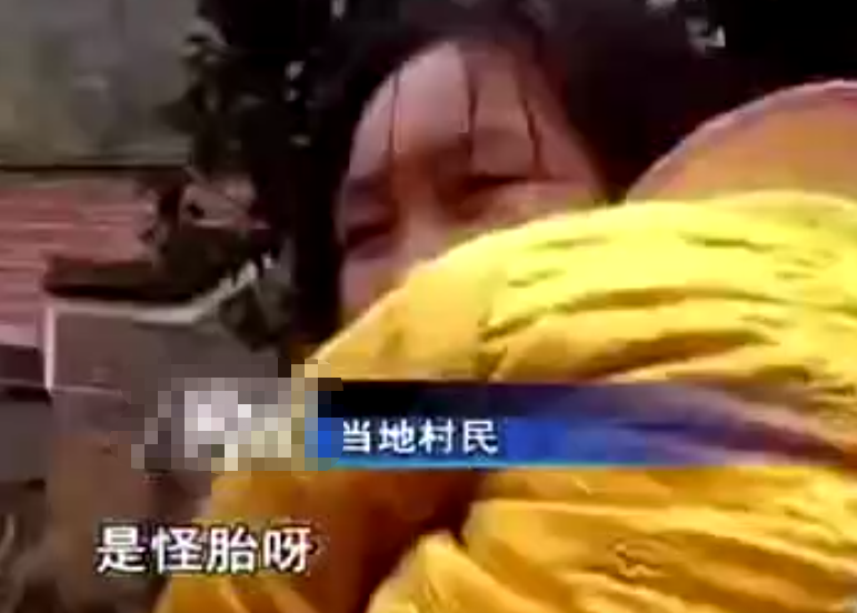 2009年，江西夫妇生下怪异婴儿，全身长满“树皮”医生被吓出冷汗