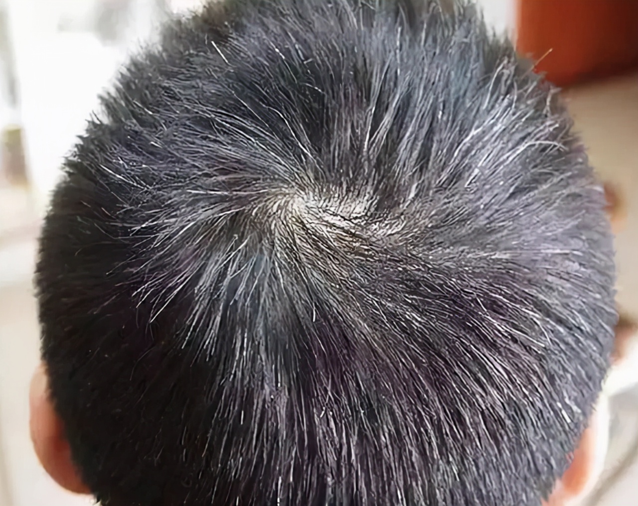 白发长在哪，病就从哪出？长在两鬓、前额、后脑勺，分别暗示什么