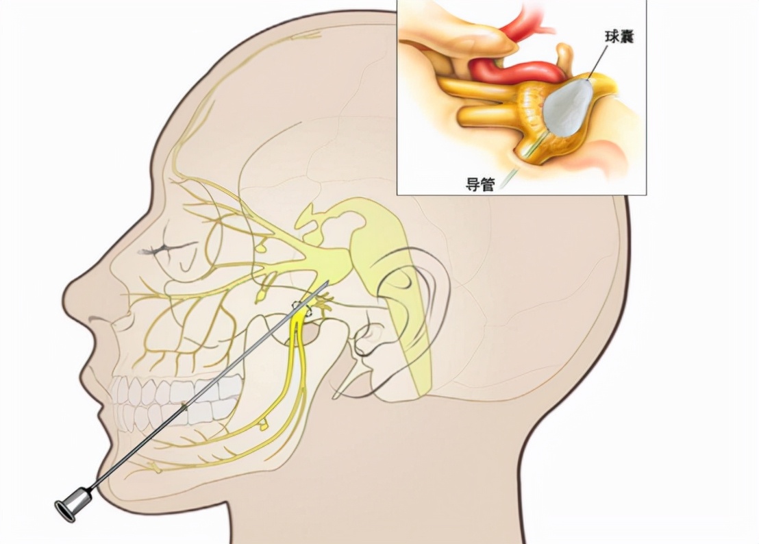 当人体出现外伤或者炎症的时候,也会引起人体的三叉神经分支部位的