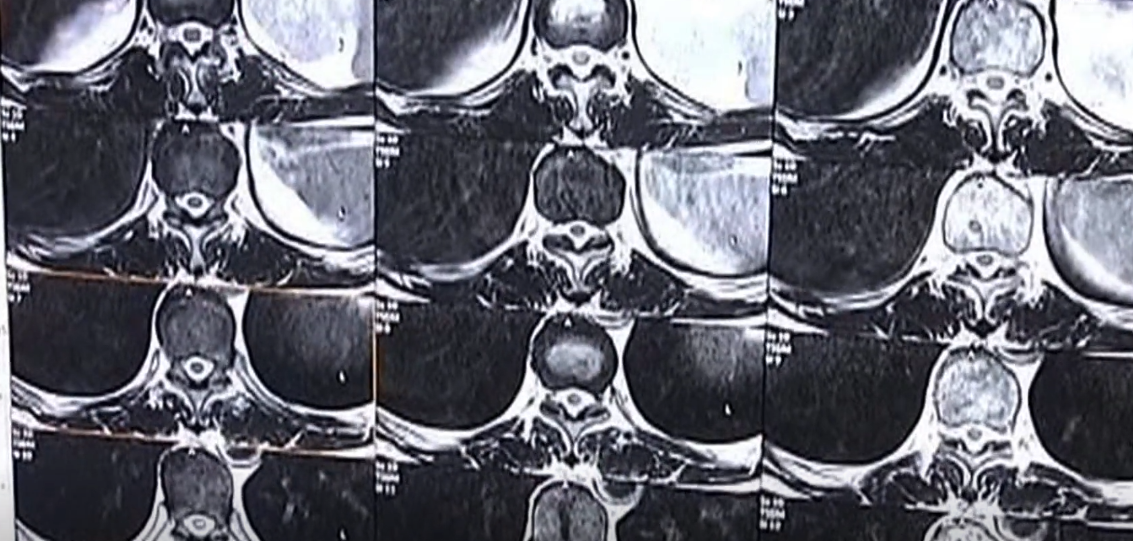 2011年女子出车祸，两年后再次起诉，要求赔偿刚出生孩子的抚养费