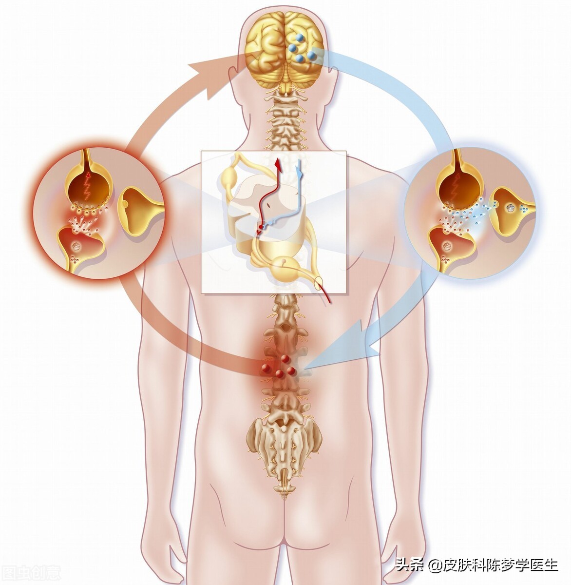 脓疱型银屑病是什么？该如何治疗？