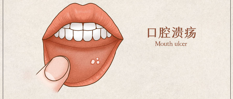 口腔溃疡反复难愈,竟查出白塞综合征?出现这4类症状可要警惕