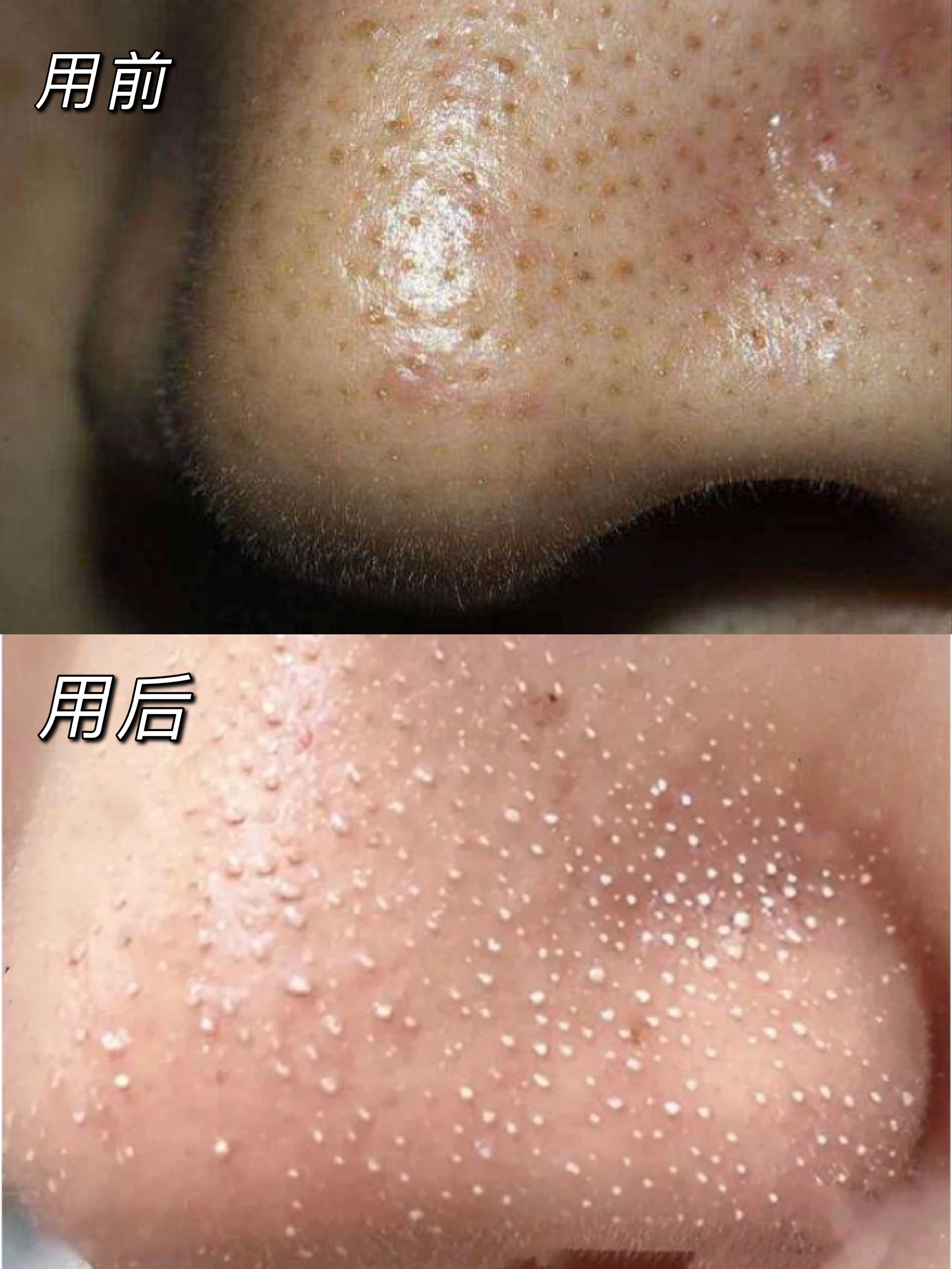 使用前后黑头的变化如下图:黑头被导出液分解后,小气泡设备闪亮登场