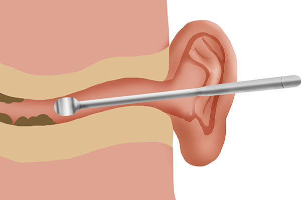 为什么有的人耳屎是干的，有的是湿的？耳屎到底用不用掏？