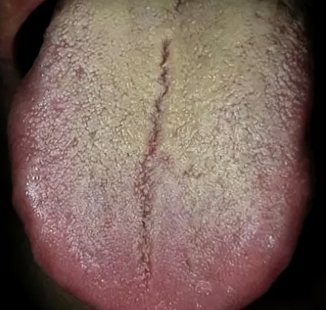 湿热舌头症状图片图片
