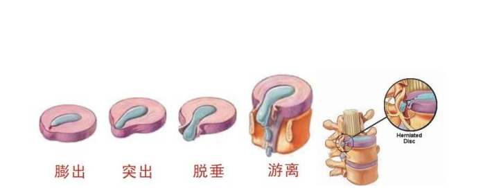 大部分腰椎间盘突出症不用手术？可以用这3类药，做好预防更重要