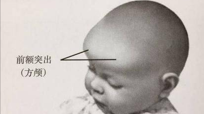 宝宝缺钙方颅图片图片