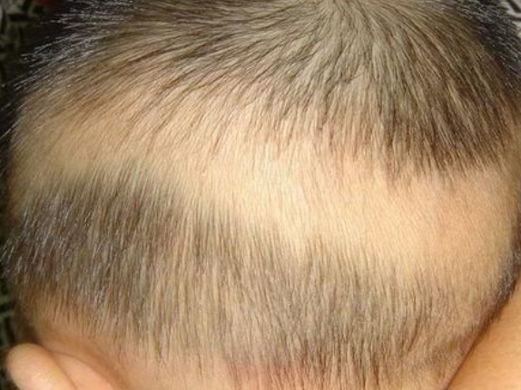 头发有这两种状态,或将代表着孩子发育有异常,营养问题值得关注
