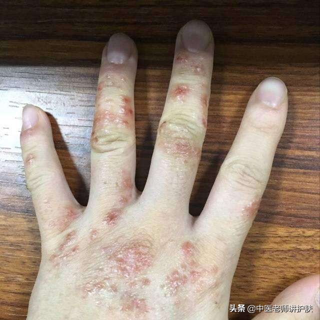 中医认为湿疮常因湿热内生,又兼外受风邪,内外相搏,风湿热邪浸淫肌肤