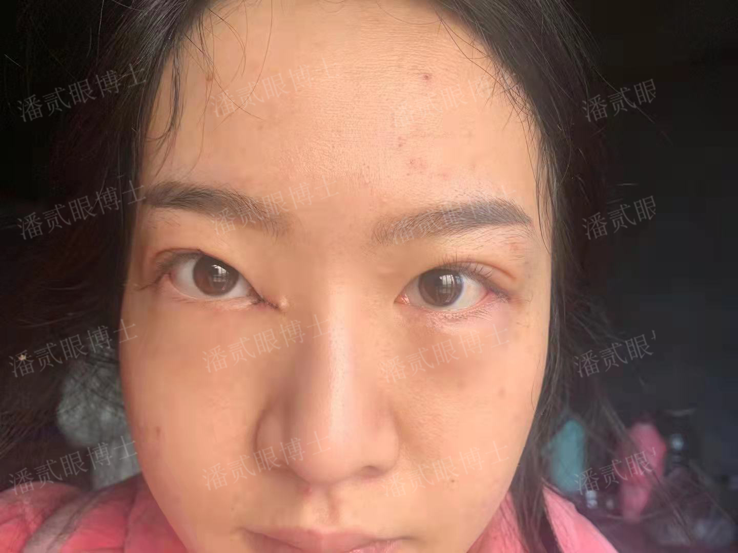 四川女子整容失败：我当初就不应该去开内外眼角，做多了只会变丑