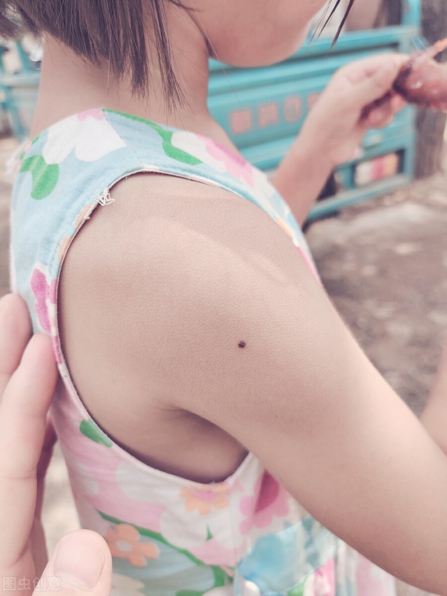 哪些痣是良性的,需要警惕的痣有什么特点?若出现5种表现要小心
