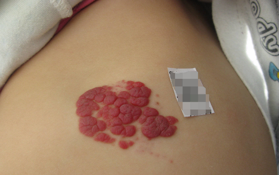 新生儿红斑:新生儿红斑,又被称之为"鲑鱼斑",是新生儿常见的血管性