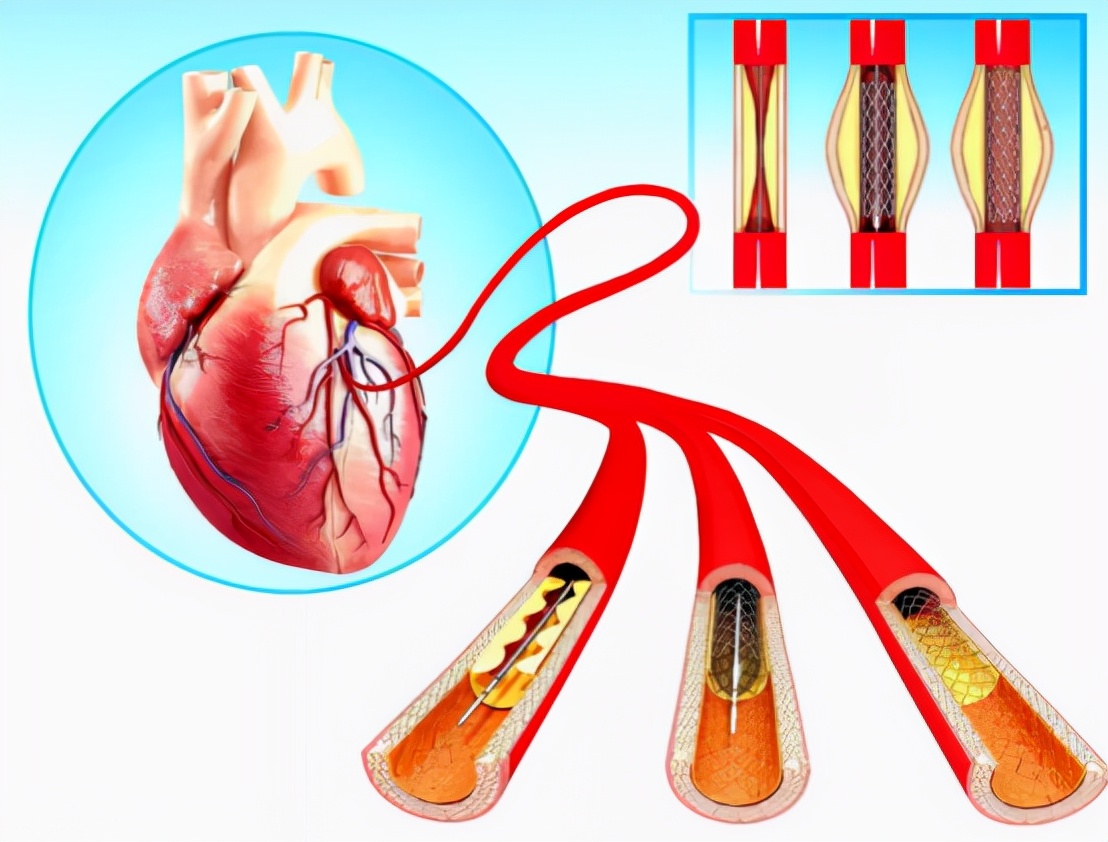 心脏支架后能活几年?和你实话实说:支撑生命的是这3点认知