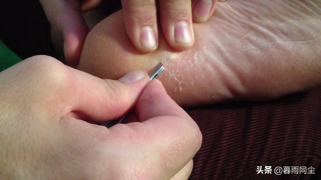 野外最常见6大伤病，背包客、户外工作者要学会（DIY）医疗应急包